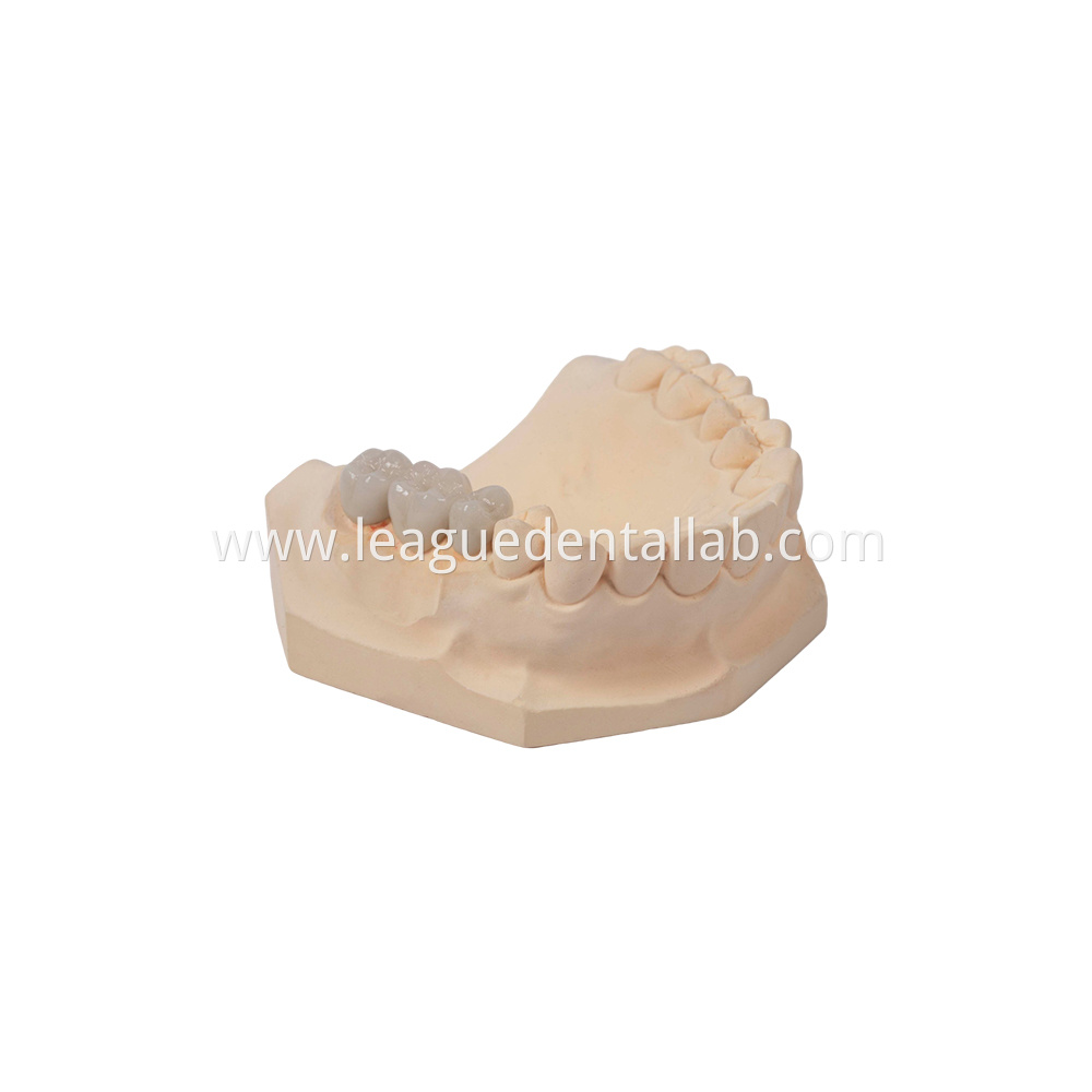 PFM,Metal crown,Fixed metal crown